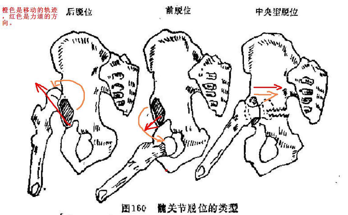同等学力西医这外科学常考点——髋关节脱位的类型