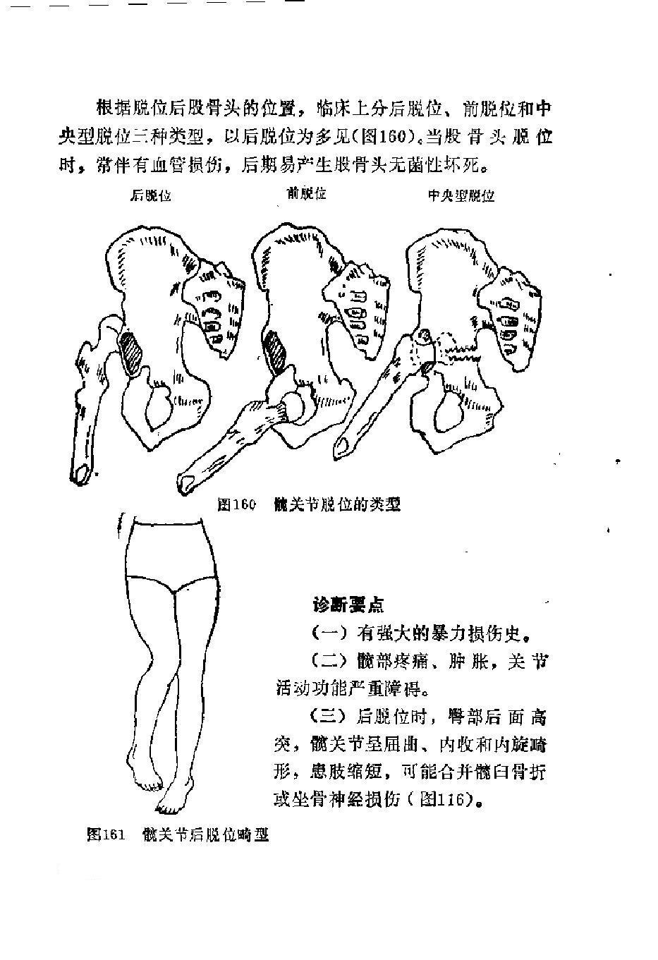 同等学力西医这外科学常考点——髋关节脱位的类型
